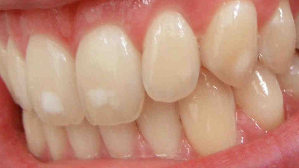 Can yellow teeth become white?