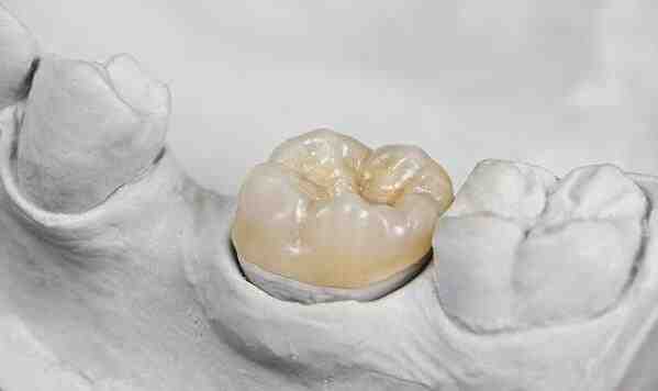 Can you fix decay under a crown?