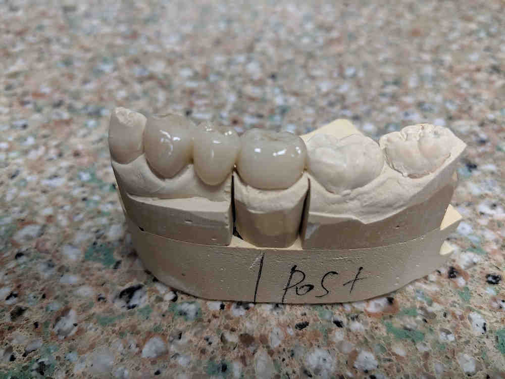 Can you get a crown without a root canal?