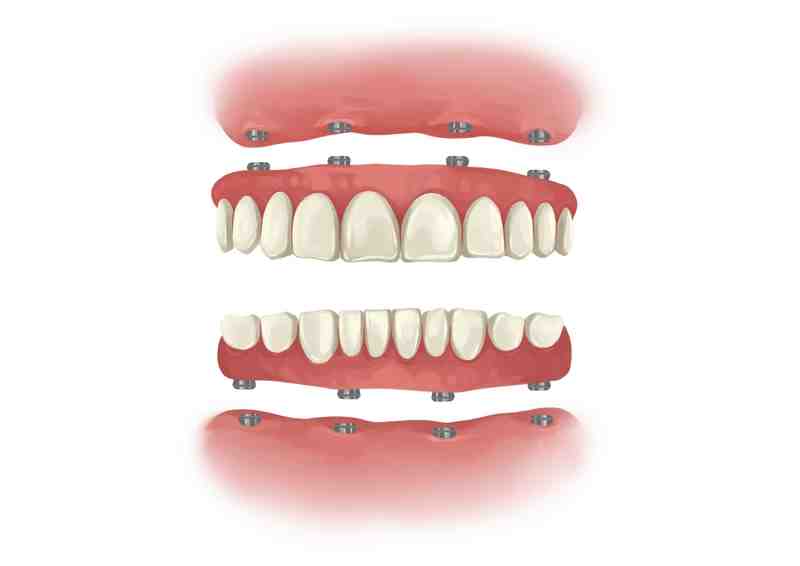 Can you get a whole mouth full of implants?