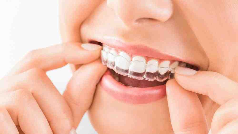 Can you get braces for a short time?