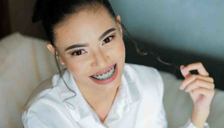 Can you get braces for cosmetic reasons?
