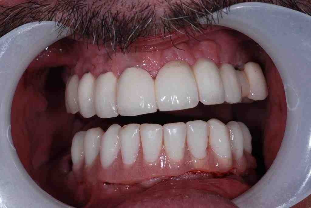 Can you get dental implants with gum disease?