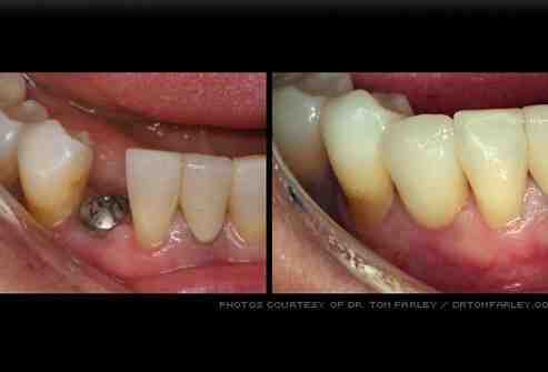 Can you get dental implants with no teeth?