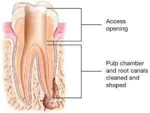 Can you have 4 root canals at once?