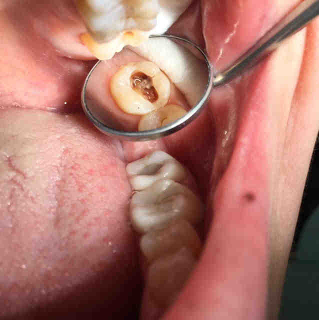 Can you still feel a tooth after a root canal?