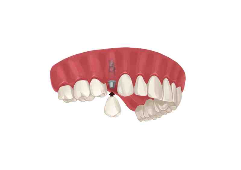 Can you write off dental implants on your taxes?