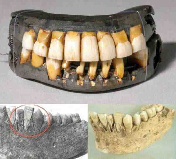 Can your mouth reject an implant?