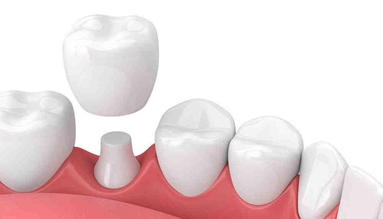 Do I need a crown after a root canal?