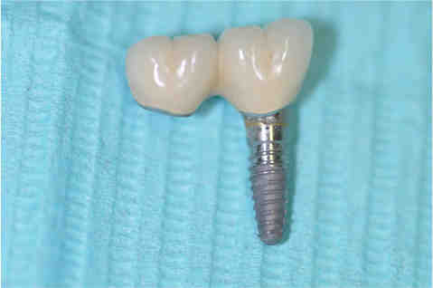 Do all implants have screws?