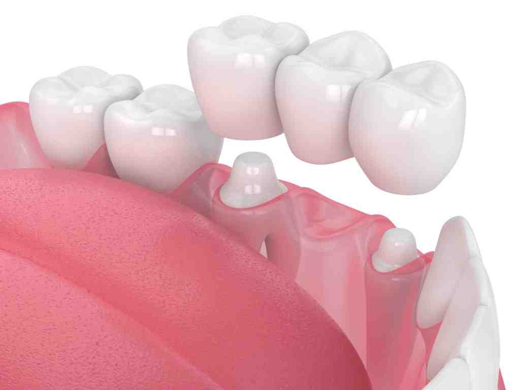 Do crowns cause gum recession?