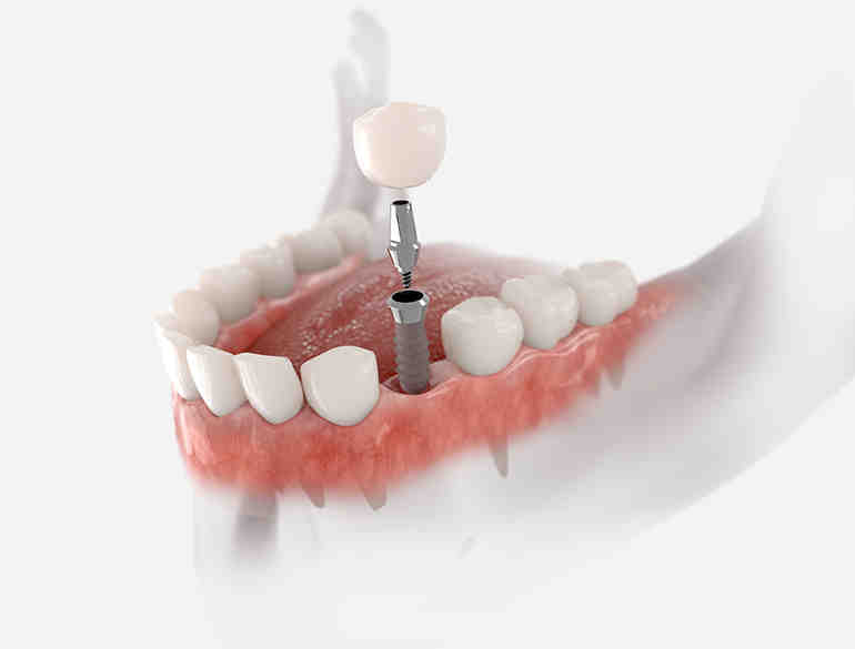 Do dental implants get cavities?