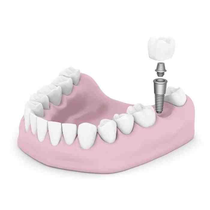 Do dental implants hurt more than tooth extraction?