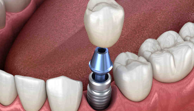 Do i need sedation for dental implants