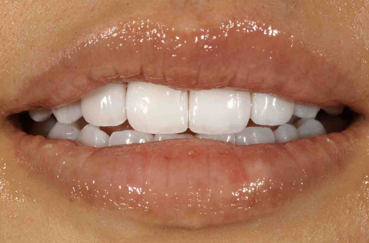 Do implants get cavities?