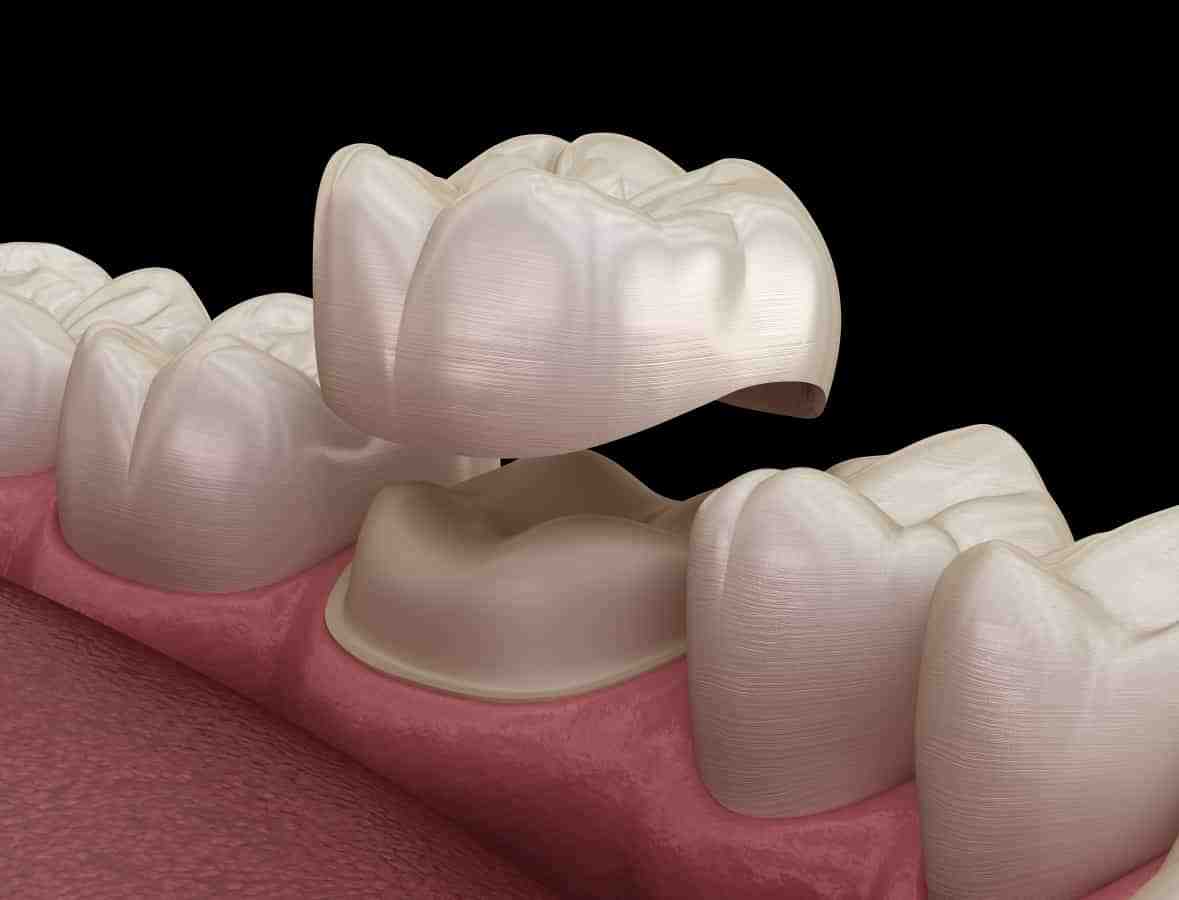 Do they shave your teeth for crowns?