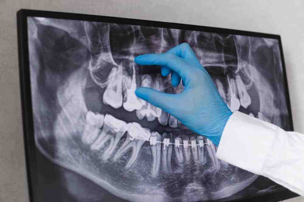 Do you feel pain during tooth extraction?
