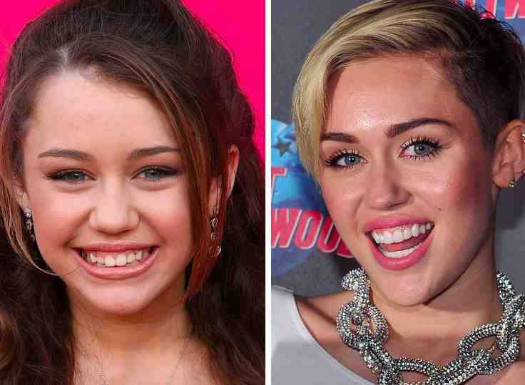 Does Miley Cyrus have dentures? - Dental News Network