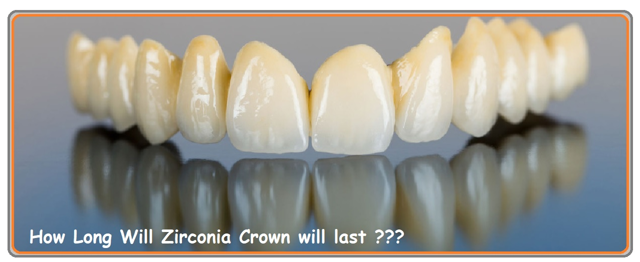 How long will a crown last? Dental News Network