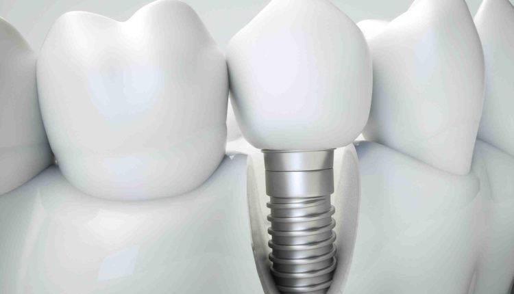 Does a fractured dental implant need to be removed?