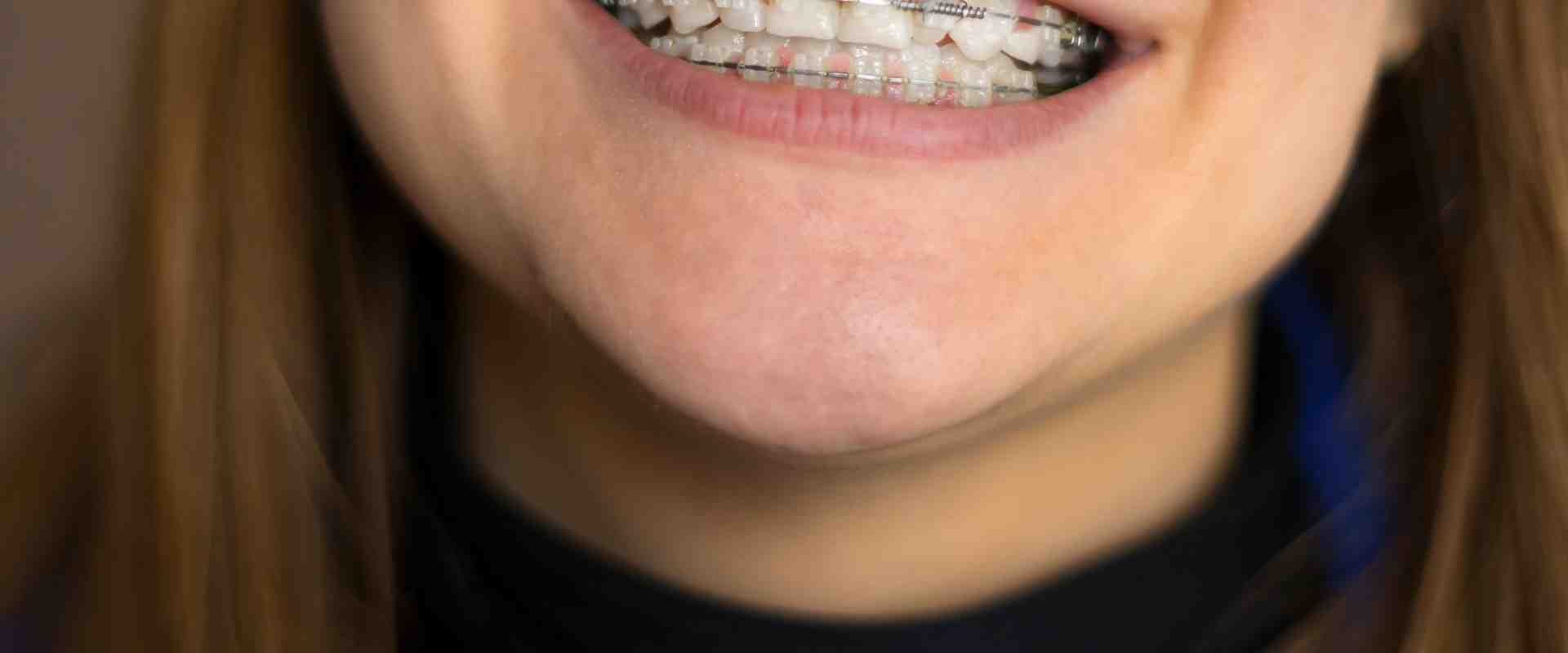 Does having braces count as plastic surgery?