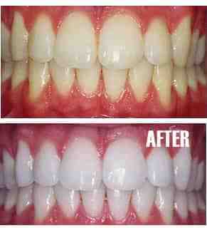 Does teeth whitening damage your teeth?