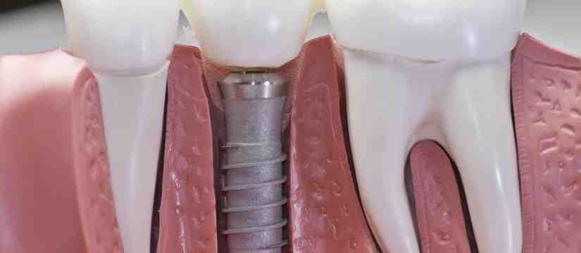 How can I ease the pain of dental implants?