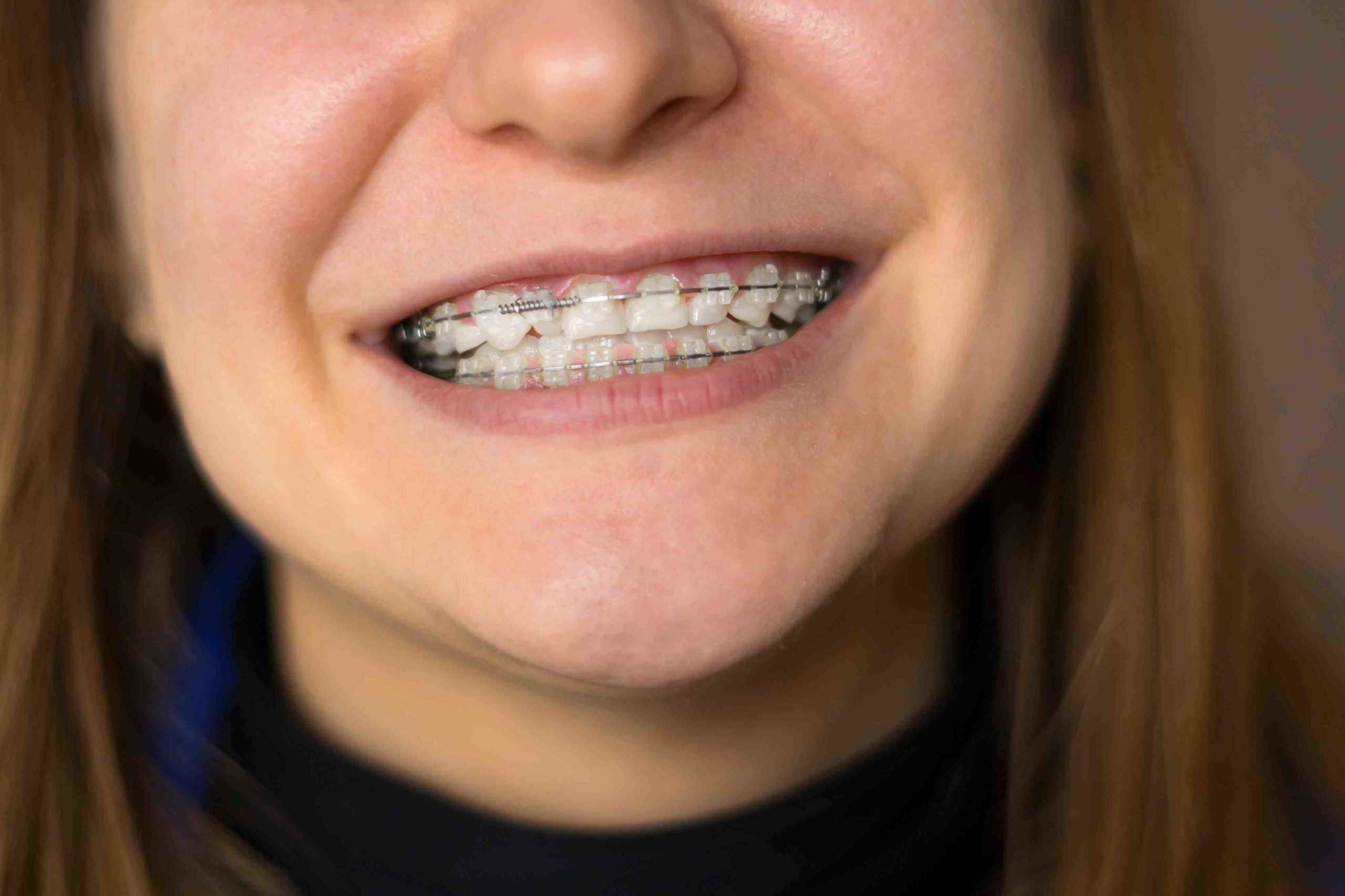 How can I hide my braces while talking?