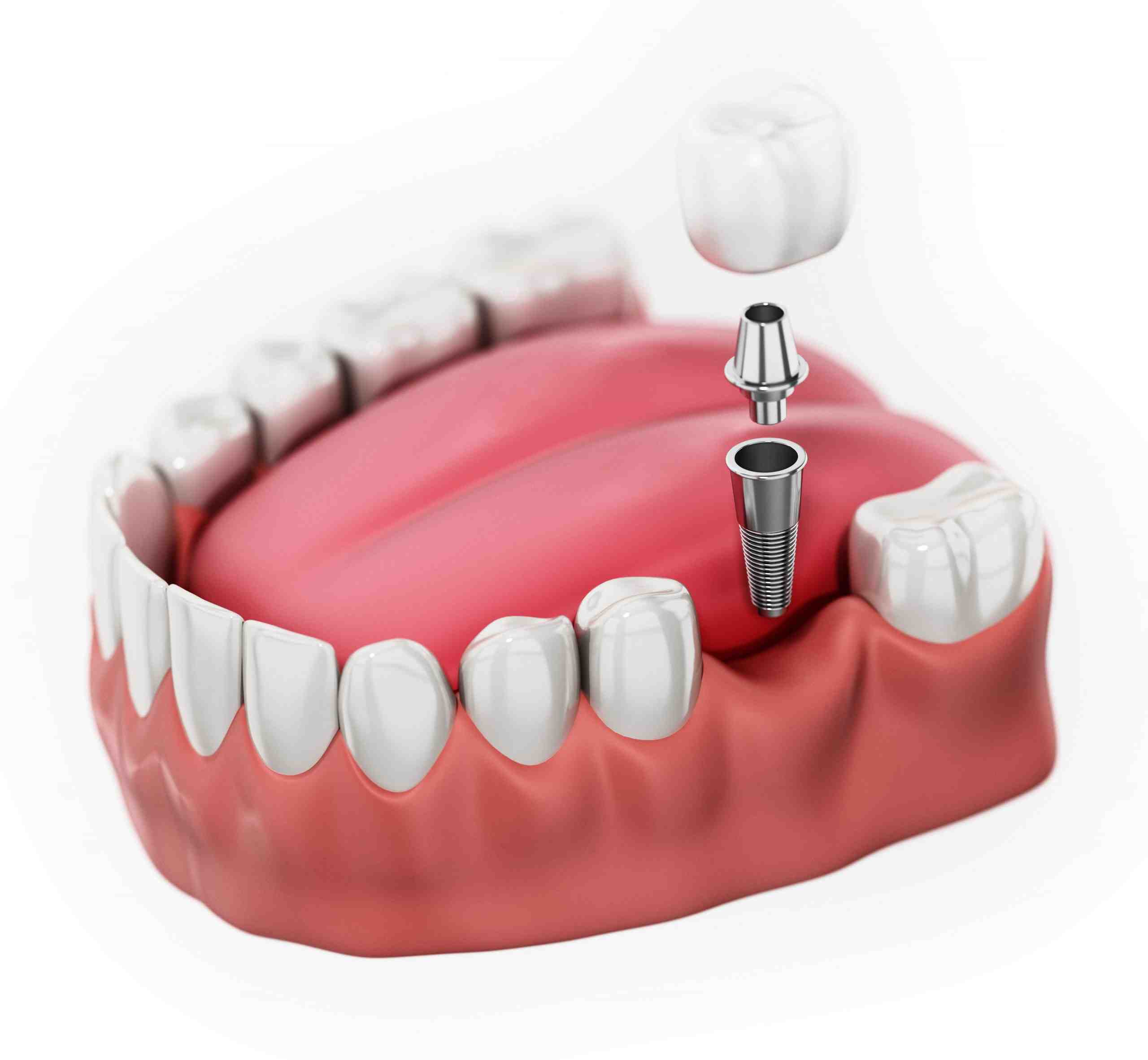 How can I keep my dental implants clean?
