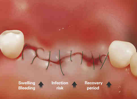 How can I stop my implant from hurting?