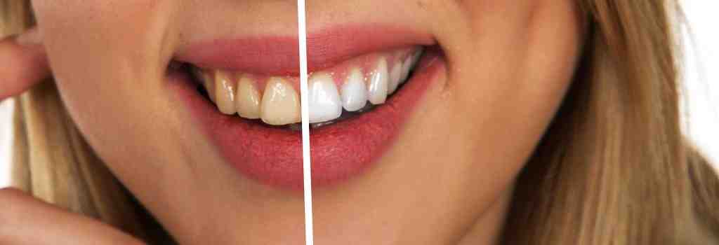 How can I whiten my yellow teeth in one day?