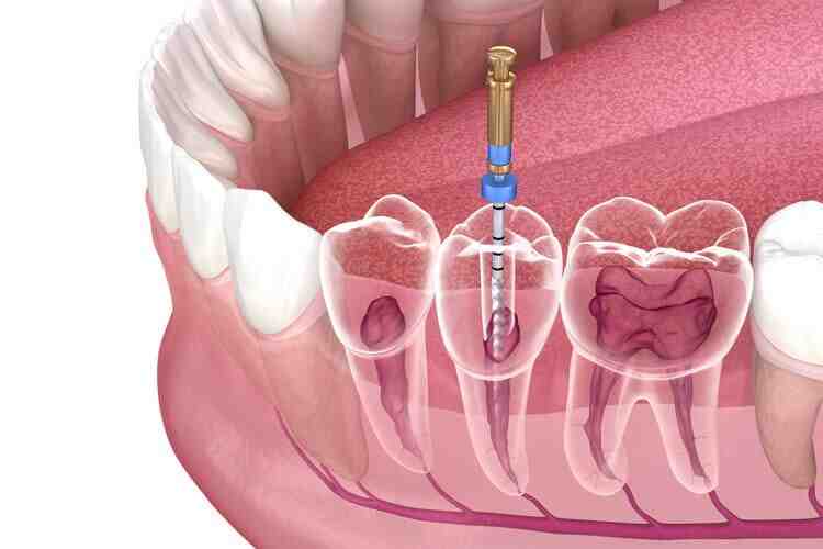 How common is root canal failure?
