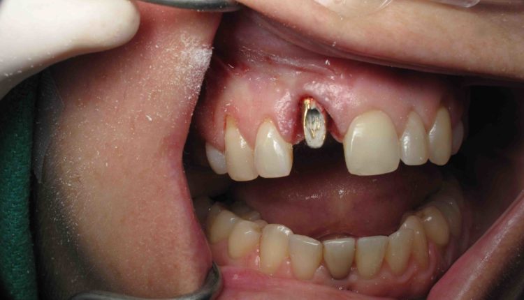How deep should a dental implant be placed