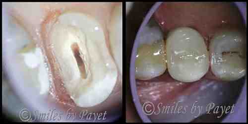 How do I know if my root canal failed?