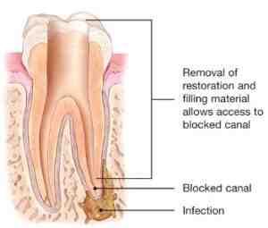 How do I know if my tooth infection has spread to my jaw?