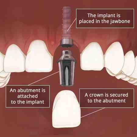 How do you floss around implants?