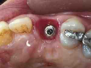 How do you get rid of an infected dental implant?