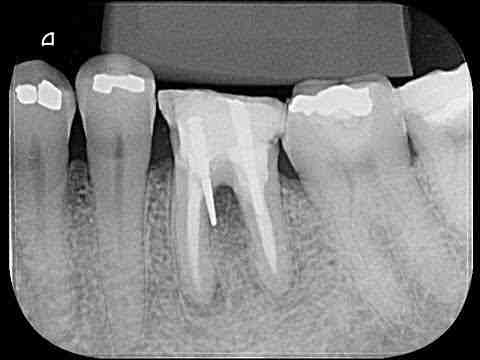 How do you know if a tooth infection is killing you?