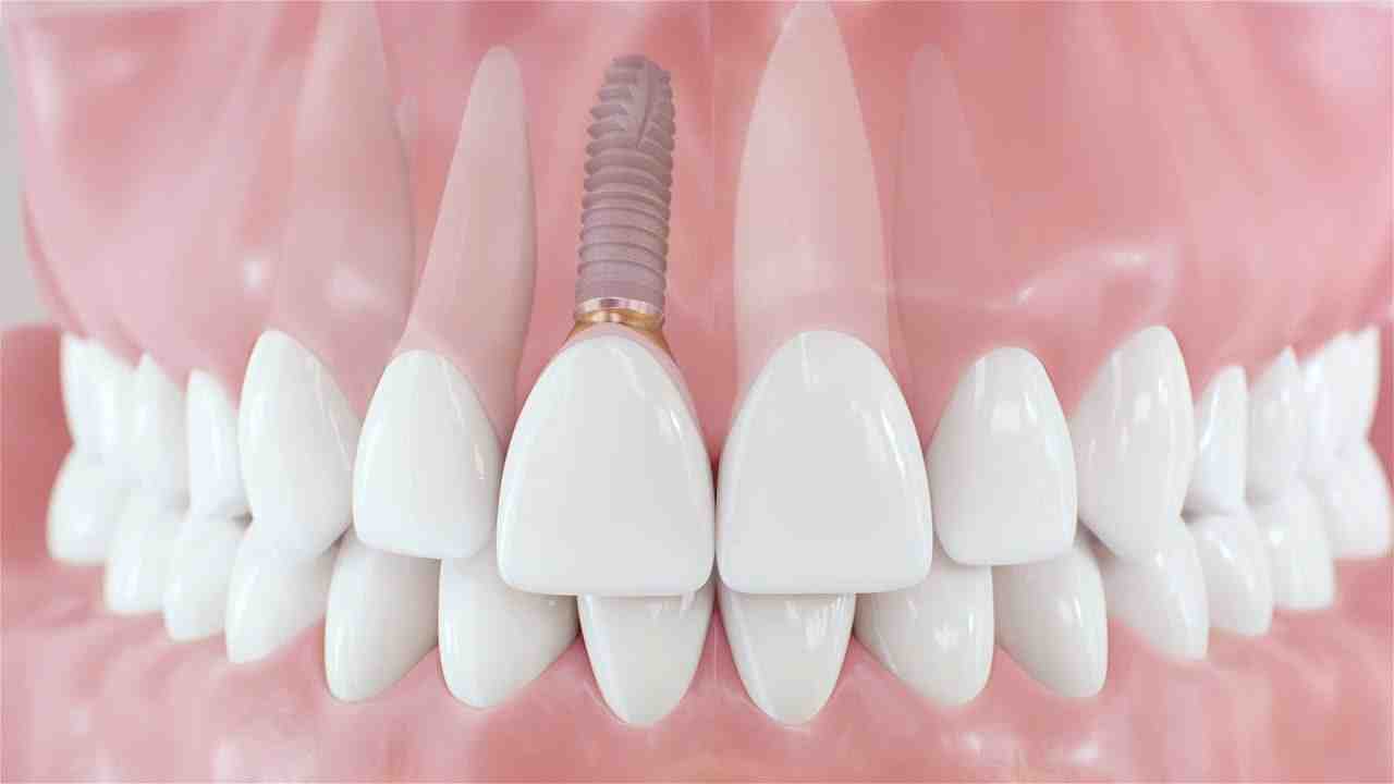Should my dental implant post be visible? Dental News Network
