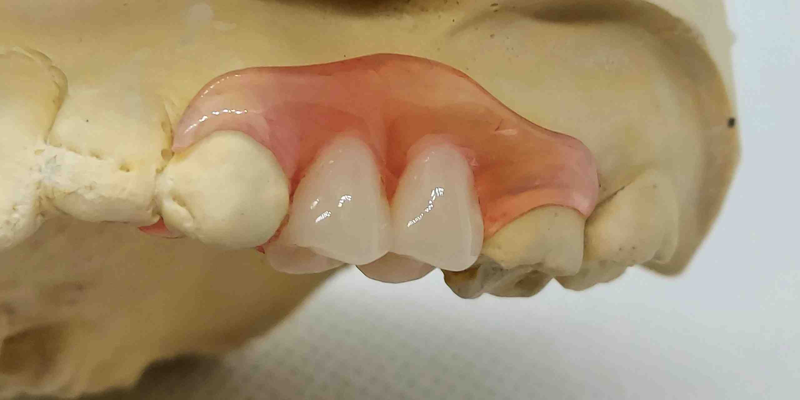 How do you remove a single tooth denture?