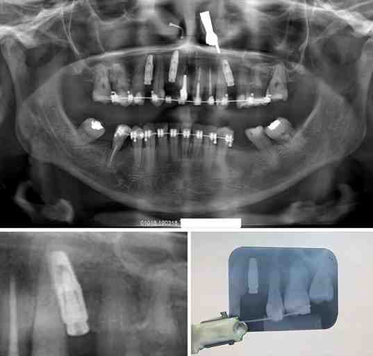 How do you save a failed implant?
