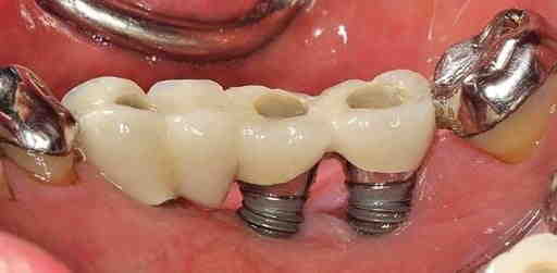How does a dentist fix a failed implant?