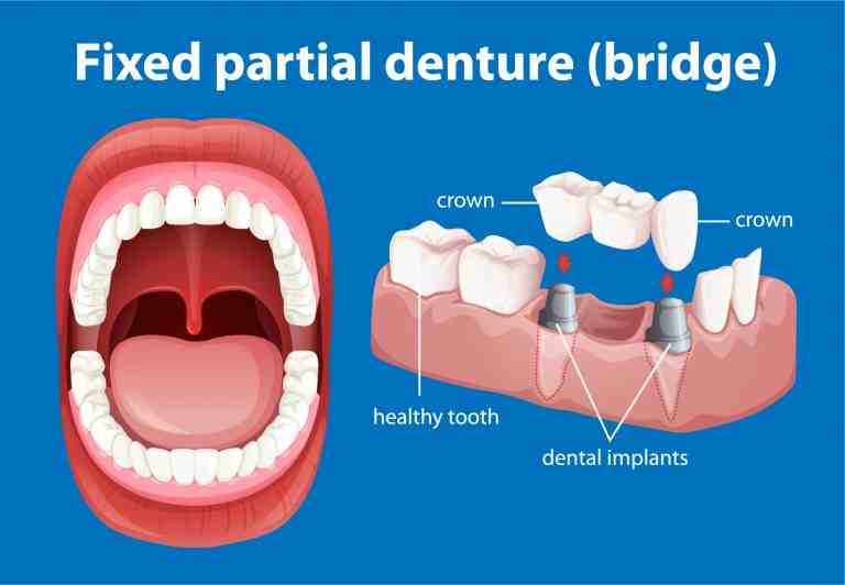 How long after dental implant surgery can I eat?