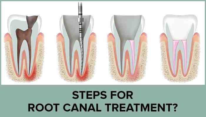 How long can you wait to get a root canal?