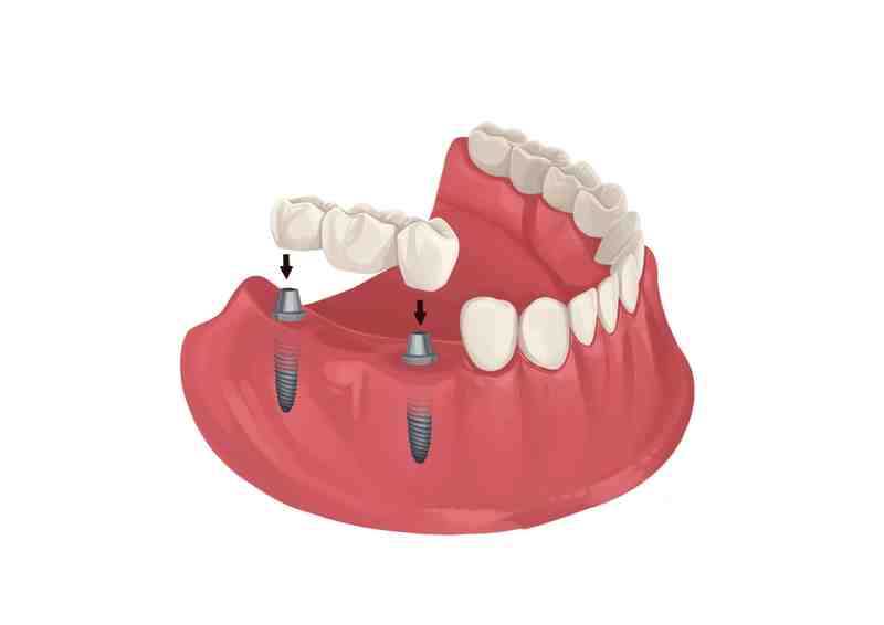 How long does a dental implant procedure take?