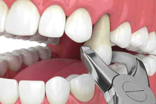 How long does a dental implant procedure take?