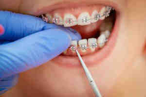 How long does bonding last on teeth?