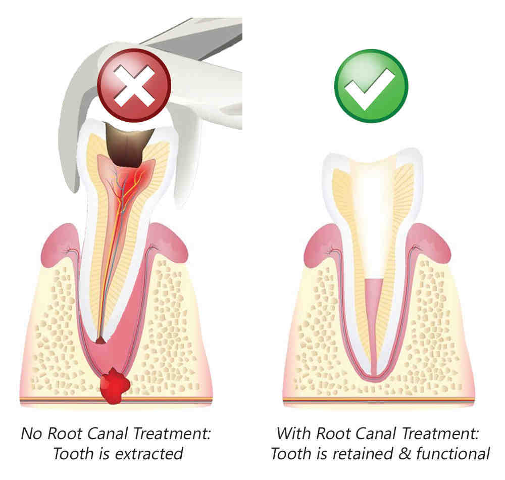 Which is better tooth extraction or root canal? - Dental News Network
