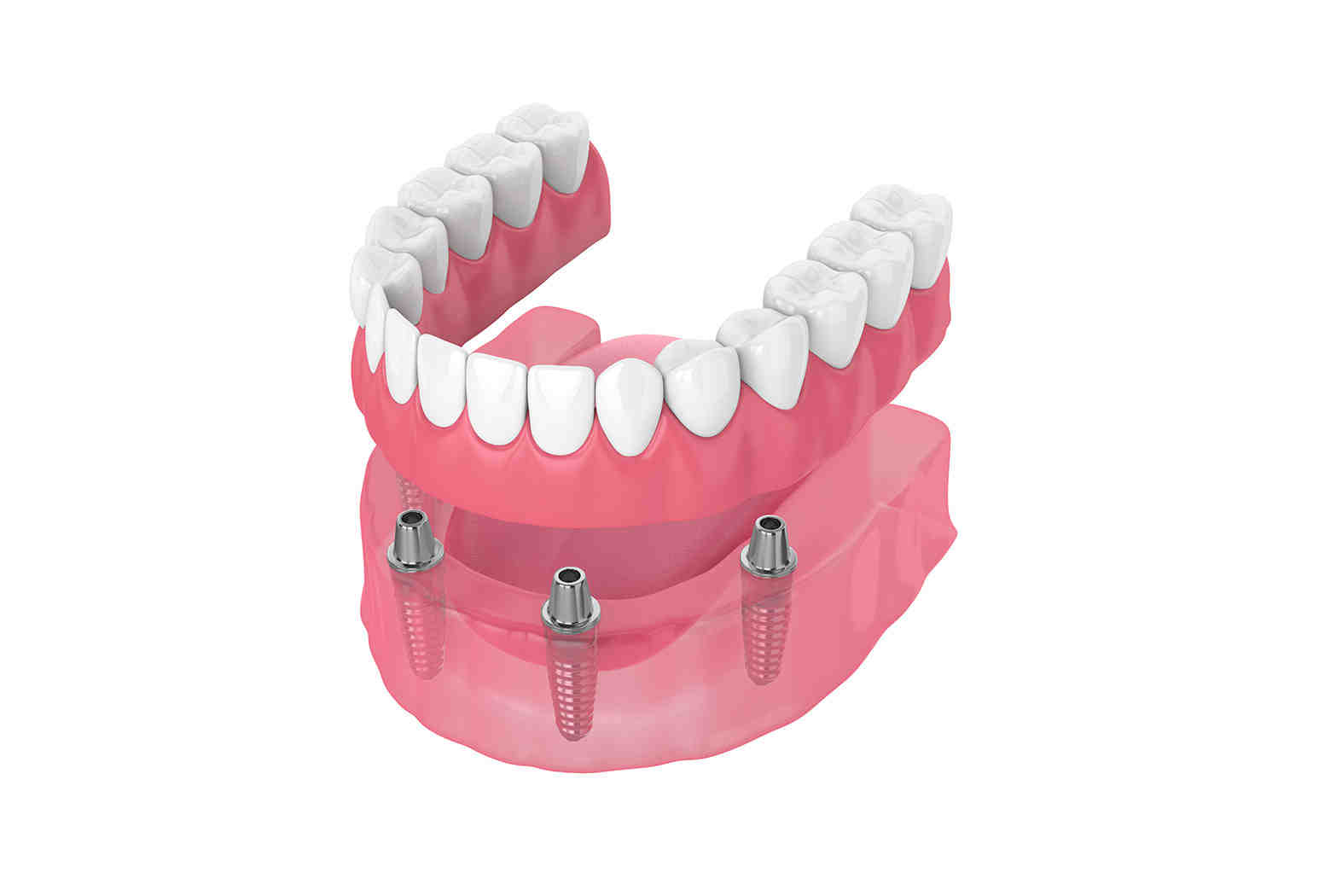 How long does it take for dental implants to fuse to bone?