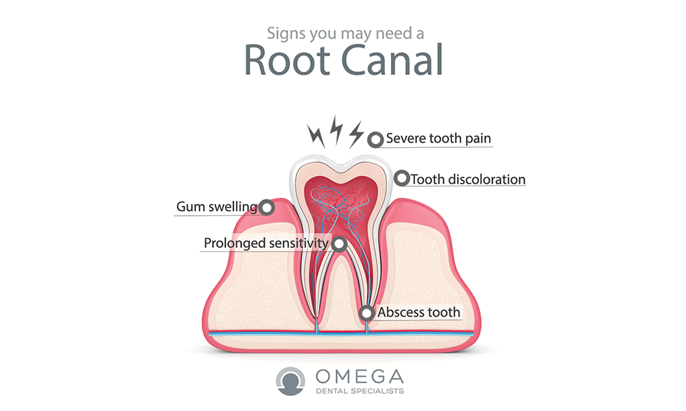 Why are root canals painful? - Dental News Network